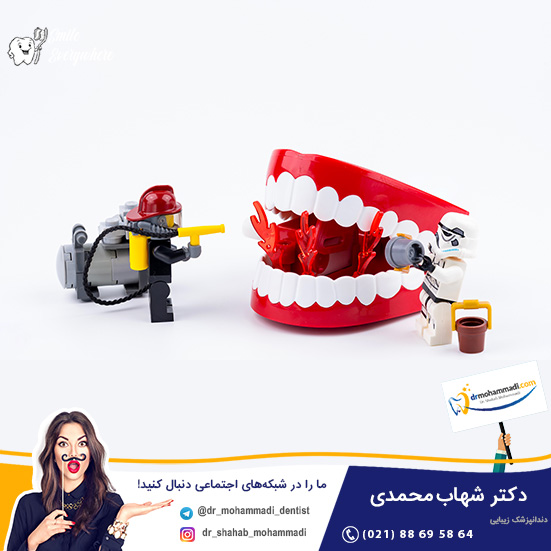 فاصله زمانی بین کشیدن دندان و ایمپلنت چقدر است؟ - کلینیک دندانپزشکی دکتر شهاب محمدی